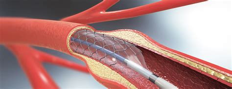 stent testing procedures